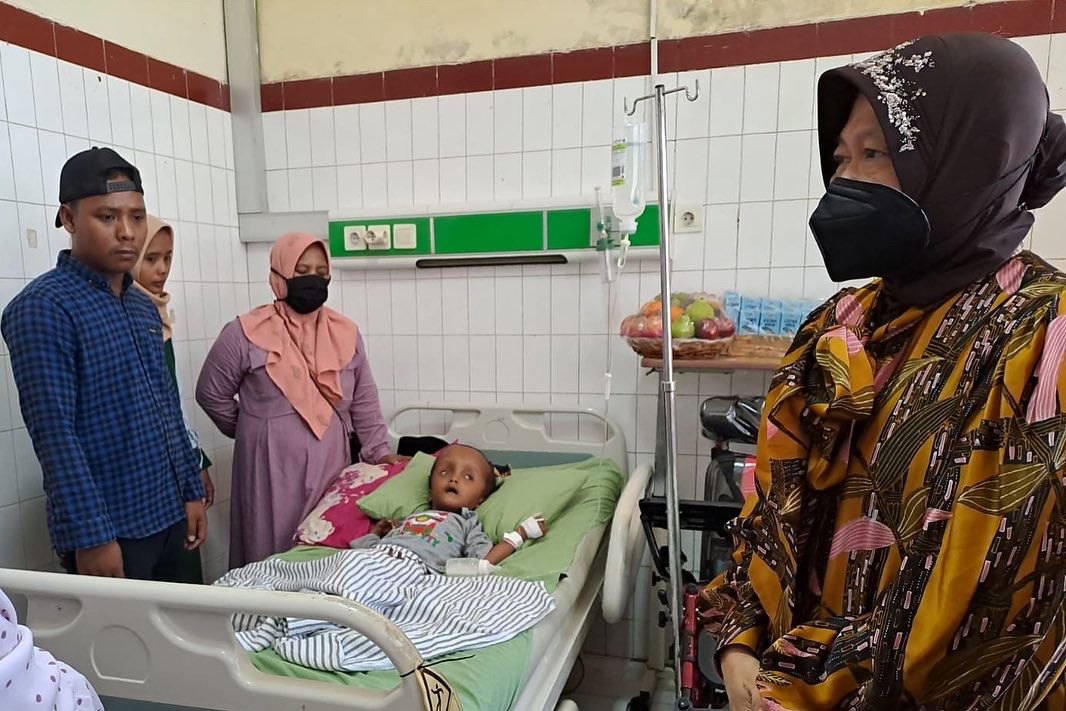 Dua Anak di Kabupaten Sumenep Idap Penyakit Hidrosefalus, Kemensos Fasilitasi Pengobatan dan Terapi